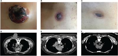 Combined High-Dose LATTICE Radiation Therapy and Immune Checkpoint Blockade for Advanced Bulky Tumors: The Concept and a Case Report